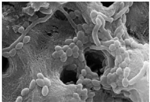 Figure 2: SEM showing bacteria and pulpal debris in the apical one-third that was not removed fully using standard irrigation protocol (Courtesy of Prof. Georgi Tomov, Plodiv, Bulgaria)