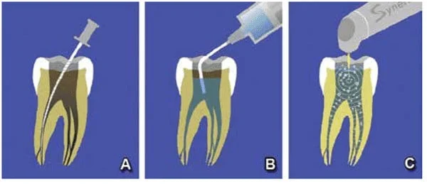 Figure 5: LiteTouch™-Induced Photomechanical Irrigation protocol (LT-IPI™): 5A. Establishment of glide path with hand files. 5B. Canal and chamber filled with NaOCL. 5C. Placement of the LiteTouch™ tip into the irrigant in the chamber and activation of the Er:YAG laser (Illustrations courtesy of Dr. Parvan Voynov, Plovdiv, Bulgaria)