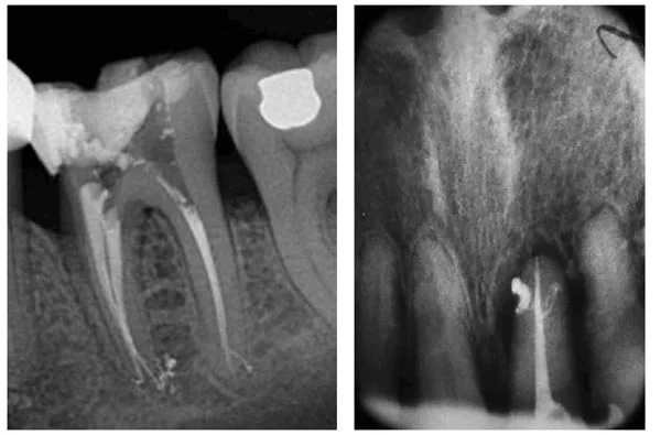 Figure 6: Accessory anatomy evident in the apical that has been filled with sealer accessible due to use of the LiteTouch™ Er:YAG laser (Photo courtesy of Dr. David Figure 7: Accessory apical anatomy filled with sealer due to use of the LiteTouch™ Er:YAG laser (Photo courtesy of Prof. Georgi Tomov, Plovdiv, Bulgaria)Guex, Lyon, France); 