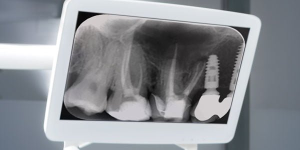 The benefits and limitations of CBCT – Endodontic Practice US – Dental ...