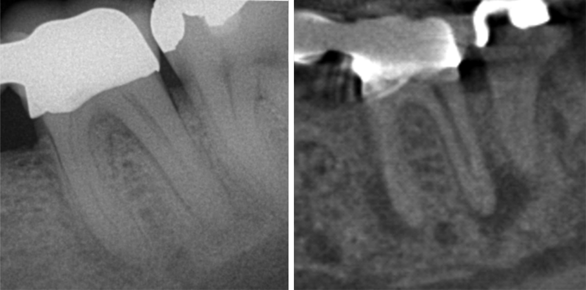 the-value-of-the-cbct-in-the-endodontic-practice-endodontic-practice