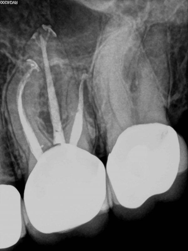 Wave One For Rct System Ways to use WaveOne® Gold reciprocating instruments | Endodontic ...