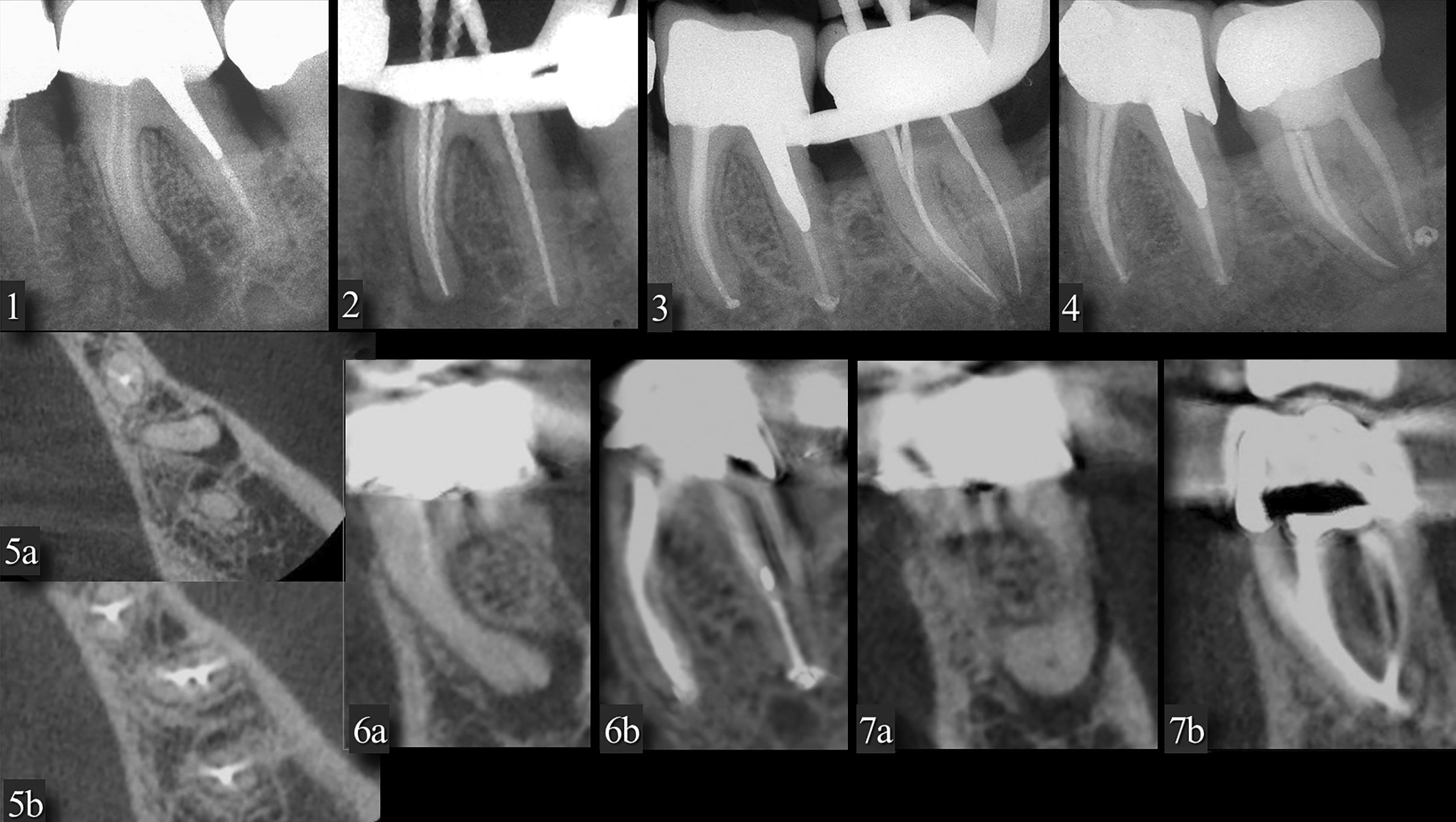 A comparison of two carrier-based obturators: Thermafil and GuttaCore ...