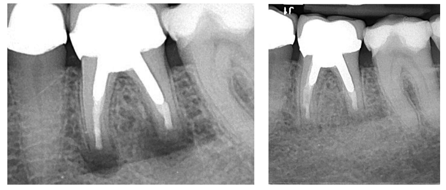 The benefits of the cortical window approach | Endodontic Practice US