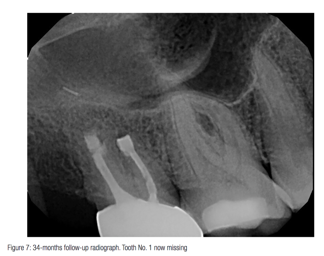 Intentional replantation in an emergency situation Endodontic Practice US