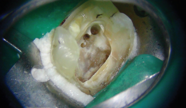 A methodical approach to a necrotic tooth