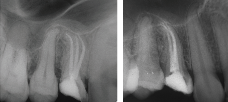 modern-instrumentation-addresses-tooth-with-three-root-canals