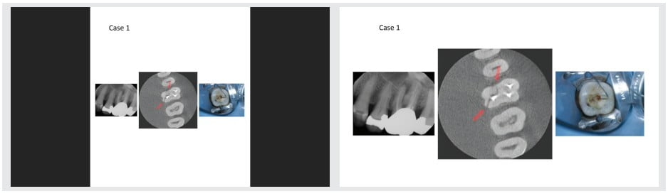 Figures 1A-1B: On the left, a less wide resolution will present with black bars to each side. A correct size or resolution will cover the screen for full impact. (All clinical images herein courtesy of Diwakar Kinra, DDS, MS)