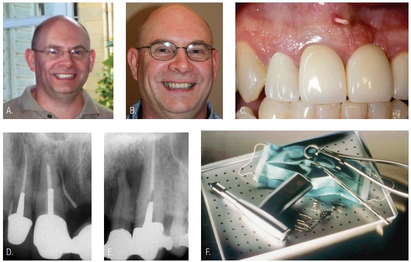 Figures 1A-1F: 1A. The patient’s smile 8 years prior to his car accident when he lost tooth No. 9. 1B. The sinus tract tracer appeared 1 year after the third bridge placement. 1C. Radiograph of gutta-percha cone tracing the sinus tract to the mesial midroot of tooth No. 8. 1D. Periapical radiograph of abutment Nos. 10 and 11; No. 10’s pulp tested nonvital. 1E. CORONAflex™ (KaVo) crown and bridge remover. 1F. The bridge was removed with CORONAflex. Floss was tied to bridge for removal safety