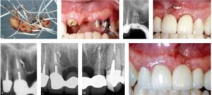 Figures 1G-1N: 1G. Previously prepared teeth. 1H. A downpack with visually obturated lateral and apical portals of exit (POEs). 1I. Sealer extruded from the sinus tract; surplus subsequently removed with a 2 x 2 gauze. 1J. Posttreatment radiograph. 1K. A 22-year posttreatment image showing healed lateral and apical LEOs of No. 8. 1L. The healed No. 10 LEO. 1M. Healed sinus tract facial to No. 8. 1N. Final (Case by endodontist Dr. John West, Tacoma, Washington)