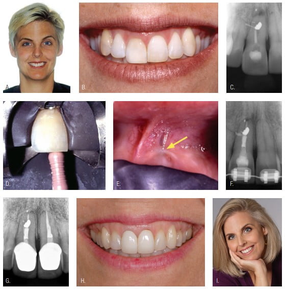 Figures 2A-2I: 2A. Smiling patient before treatment. 2B. Uneven gingival levels. 2C. Periapical image of a sinus tract tracer to the distal lateral portion of the root canal system. 2D. The No. 6 endodontic file was placed. 2E. The rubber dam was retracted, revealing the file penetrating through the gingiva. 2F. Posttreatment nonsurgical endodontic treatment. 2G. The 23-year posttreatment of tooth No. 8, and later tooth No. 10. 2H. Present-day restorative. 2I. The patient was pleased with her smile, and improved self-esteem gave her new confidence (Case collaboration by endodontist Dr. John West; orthodontist Dr. Vince Kokich Jr, Tacoma; and prosthodontist Dr. Gregg Kinzer, Seattle.)