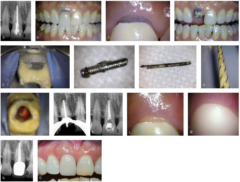 Figures 3A-3O: 3A. Pretreatment radiograph of the maxillary right central incisor. 3B. Preoperative photo showing a dark gingival area. 3C. Close-up of the dark gingival area. The patient wanted to improve the crown shape. 3D. The crown was removed. 3E. Close-up of the probable sealer, silver cone, and post staining. 3F. The post was removed. 3G. The silver cone was removed. 3H. The shaping rotary confirmed restrictive flow preparation. 3I. The cleaned root canal system. 3J. The conefit. 3K. Posttreatment and placement of a “safe bleach” barrier. 3L. Improved gingival root color after bleaching. 3M. Close-up of the gingival crown color. 3N. Post-endodontic treatment. 3O. The final, long-term 18-plus-year posttreatment (Case collaboration by endodontist Dr. John West and restorative dentist Dr. Karl Smith, Tacoma.) 