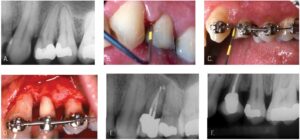 Figures 4A-4F: 4A. Pretreatment radiograph. 4B. Deep probing into the base of the mesial access perforation. 4C. Forced orthodontic eruption. 4D. Periodontal osseous recontouring. 4E. Finished endodontics and restorative. 4F. At the 26-year posttreatment appointment (Case collaboration by endodontist Dr. John West; orthodontist Dr. Vince Kokich Sr., Tacoma; periodontist Dr. Dave Mathews, Tacoma; and restorative dentist Dr. Ralph O’Connor, Tacoma.)