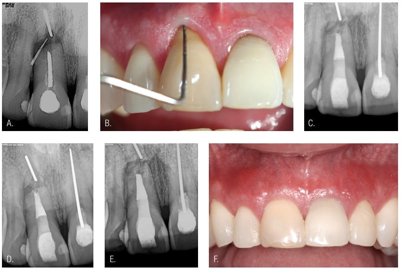 Figures 5A-5F: 5A. Pretreatment photo, showing the sinus tract tracer toward the root end. 5B. Probing WNL, but gingival recession is present. 5C. Posttreatment image. 5D. Posttreatment periapical area. 5E. At 19 years’ posttreatment. 5F. The esthetic gingival levels were restored (Case collaboration by endodontist Dr. John West and periodontist Dr. Jim Janakievski, Tacoma.)