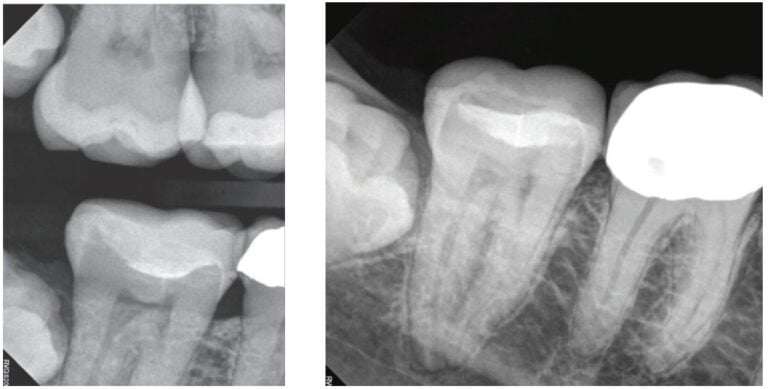 ExactTaperH DC™ — a new endodontic file system