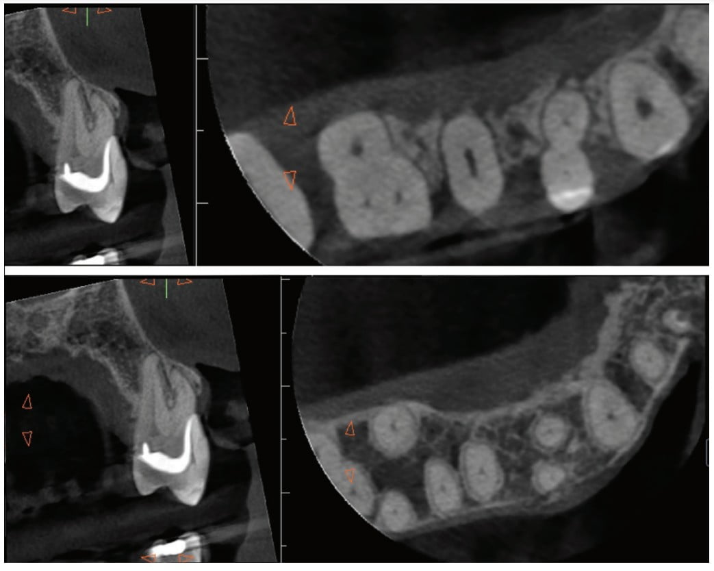 CBCT imaging — avoiding misdiagnosis