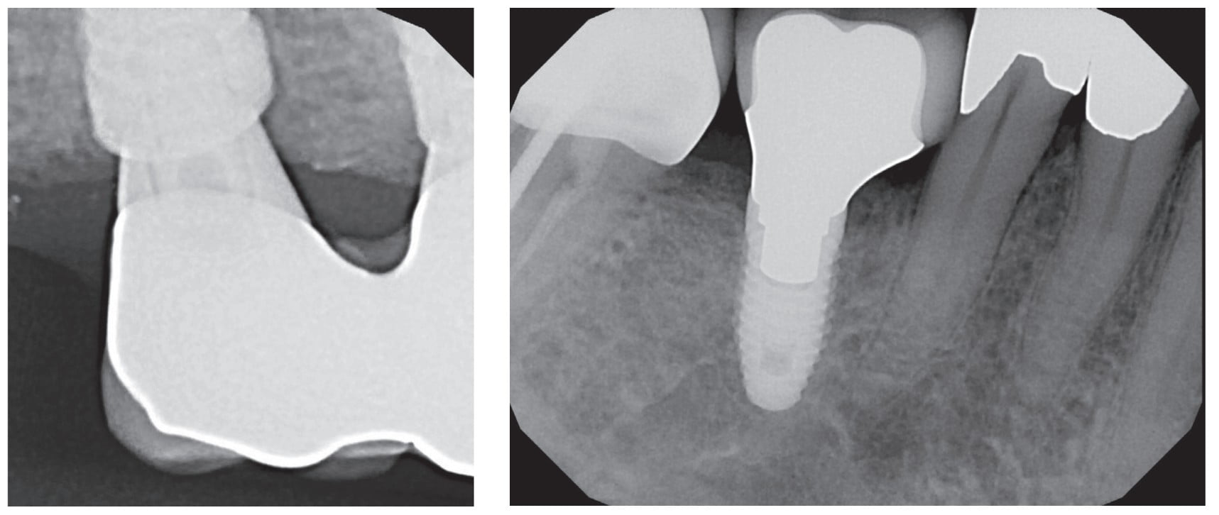 Periodontal issues and implants — management techniques