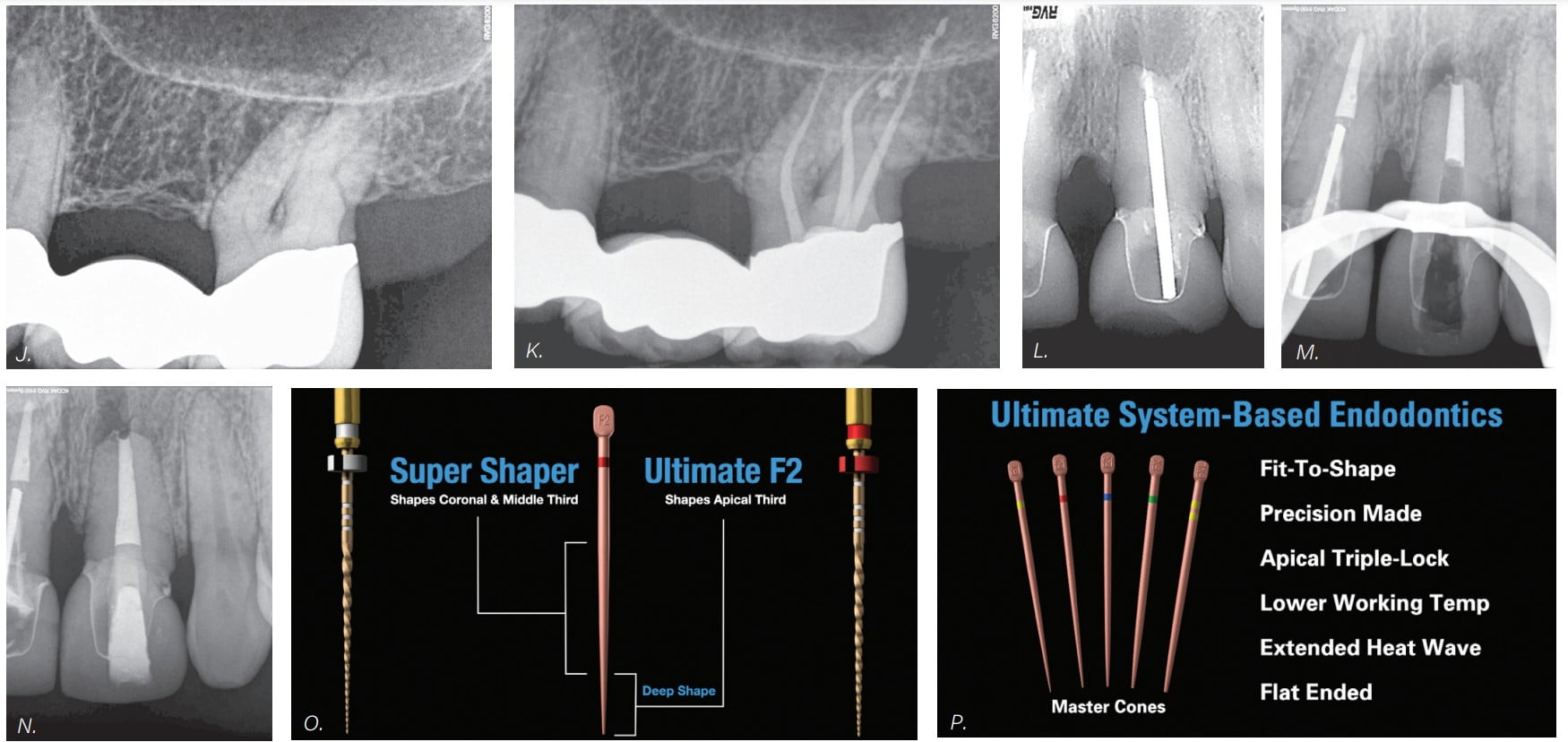 ProTaper Ultimate — the go-to endodontic-preparation rotary system