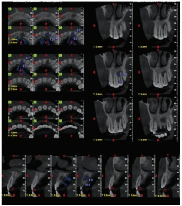 Triple antibiotic paste — latest findings and applications for endodontics