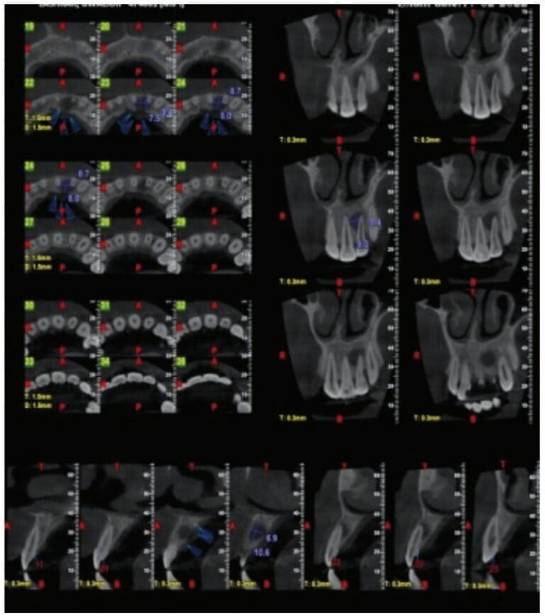 Triple antibiotic paste — latest findings and applications for endodontics