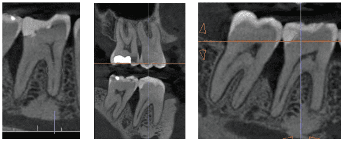 Figures 10-12: Sagittal CBCT showing the distal angular defect extending more than 2/3 length of the root;
this reflects a crack having extending apically, likely for years