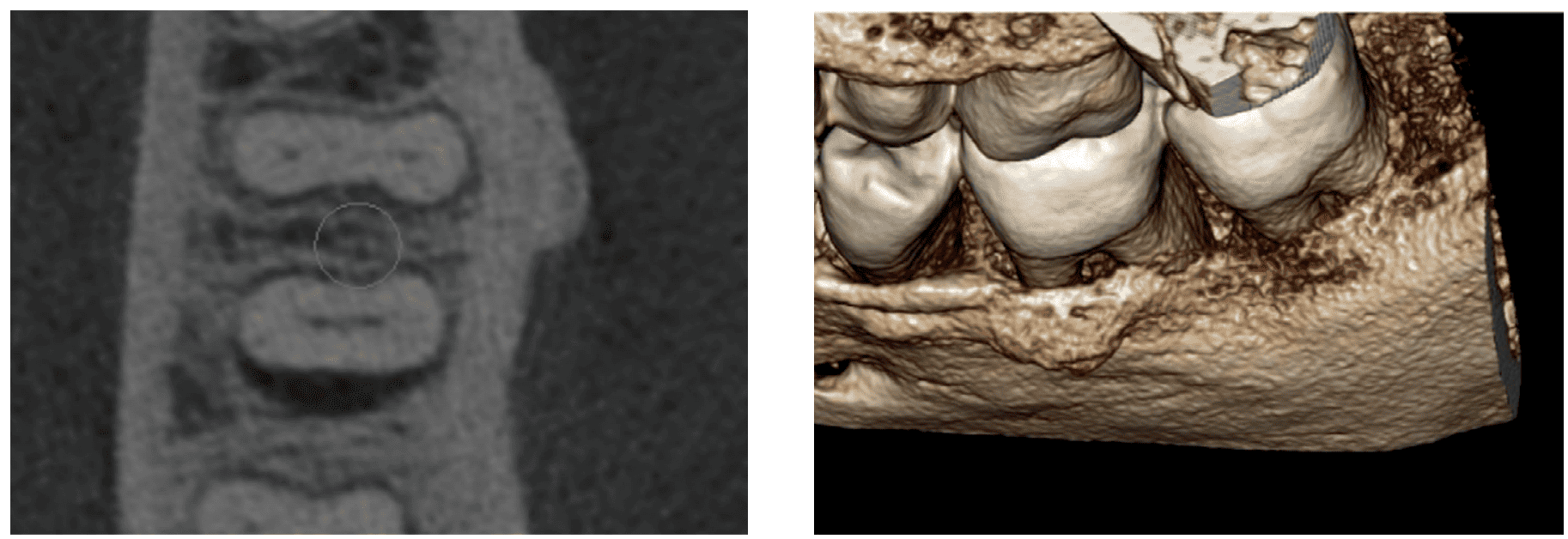 Figures 13 and 14: The axial image of the circumferential bone loss on this tooth; the 3D volume rendering
showing the very clear distal aspect of the lower second molar, because there is no bone attached there