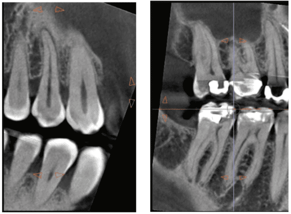 Cracked teeth — how to detect for the best prognosis