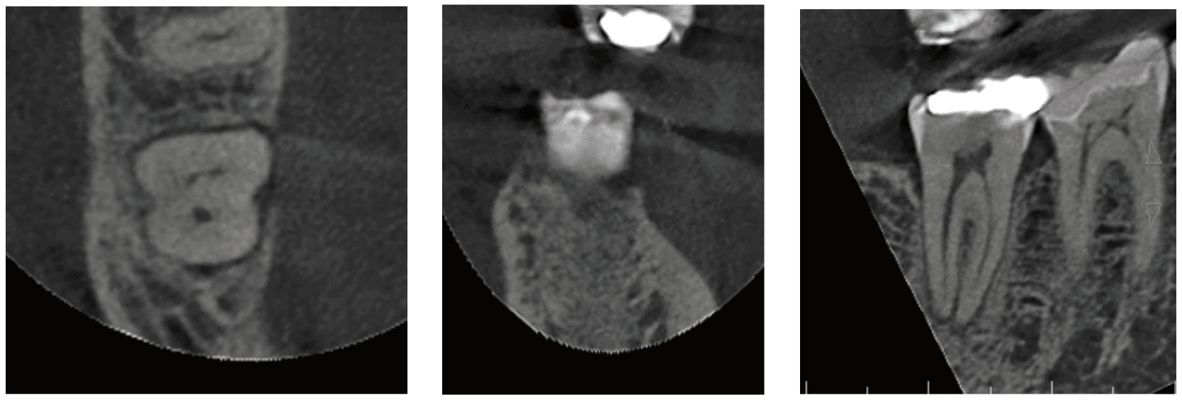 Figures 6 (left); Figure 7 Center): Dips at point of crack; Figure 8 (right)