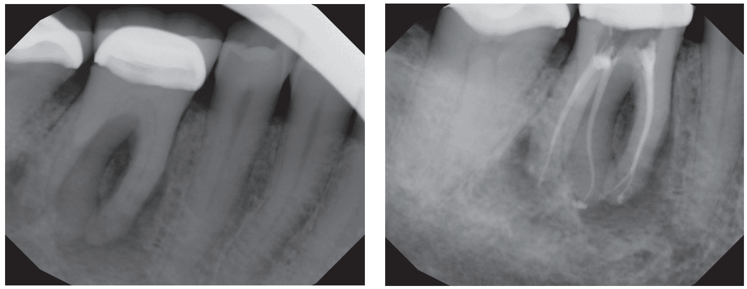 GentleWave System — minimally invasive and effective root canal cleaning